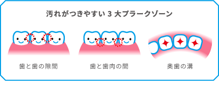 汚れがつきやすい3大プラークゾーン 歯と歯の隙間 歯と歯肉の間 奥歯の溝